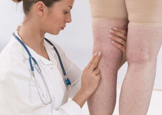 Diagnosi di vene varicose