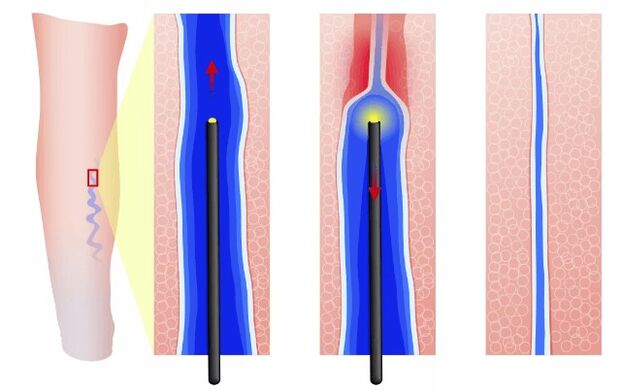 Elettrocoagulazione endovasale