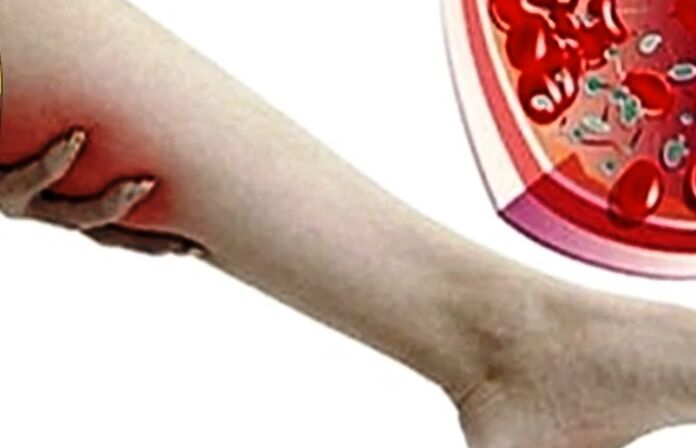 Vene varicose sulla gamba