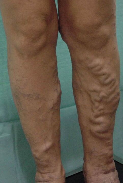 Vene varicose sulle gambe
