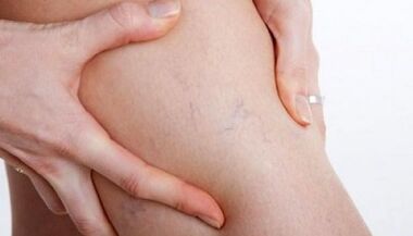 Come si manifestano le vene varicose sulle gambe