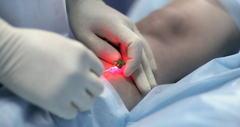 Trattamento chirurgico delle vene varicose