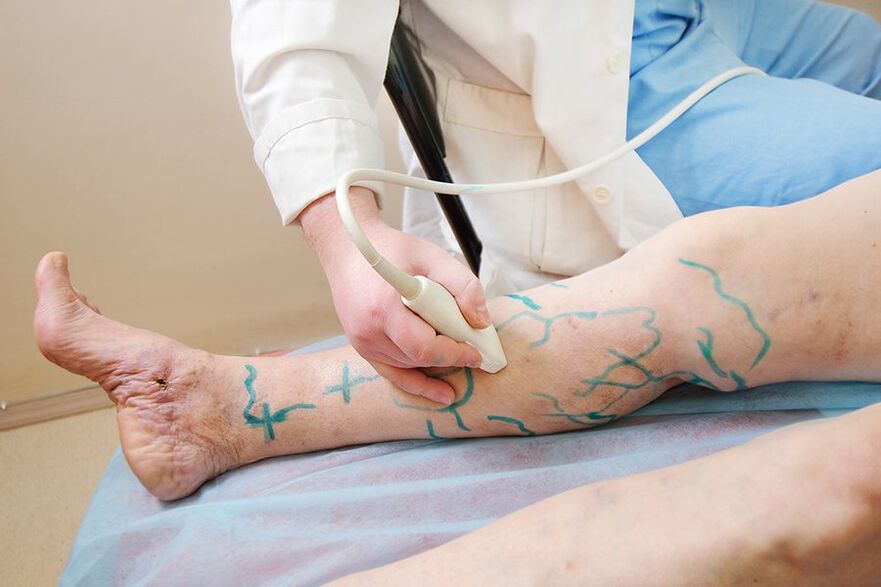 Preparazione per miniflebectomia marcatura delle perforanti della gamba, esecuzione di un'ecografia